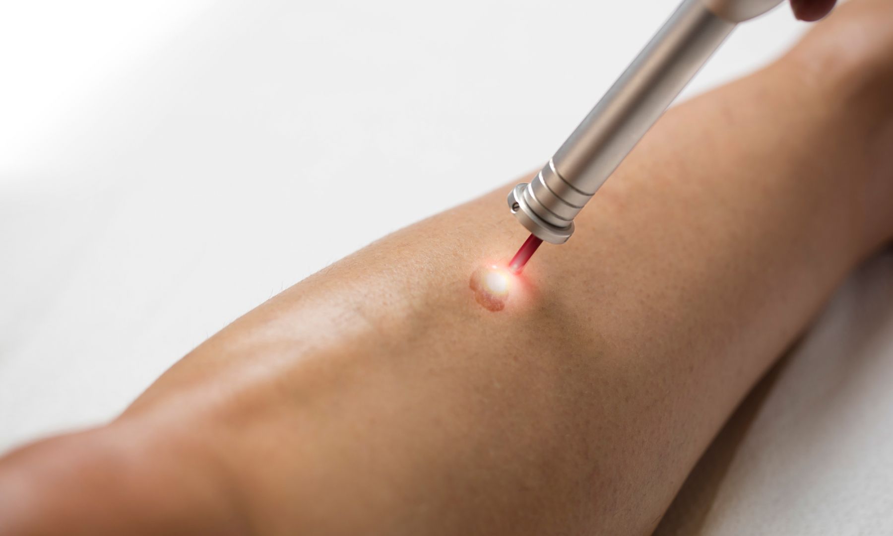 Lasermedizin - Rubin Laser(Entfernung von Tätowierungen, permanent Make ...